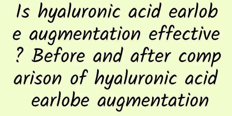Is hyaluronic acid earlobe augmentation effective? Before and after comparison of hyaluronic acid earlobe augmentation